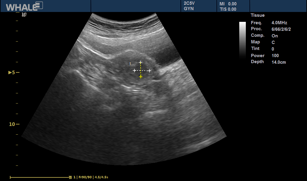 Sigma P5 Clinical Image Ovary