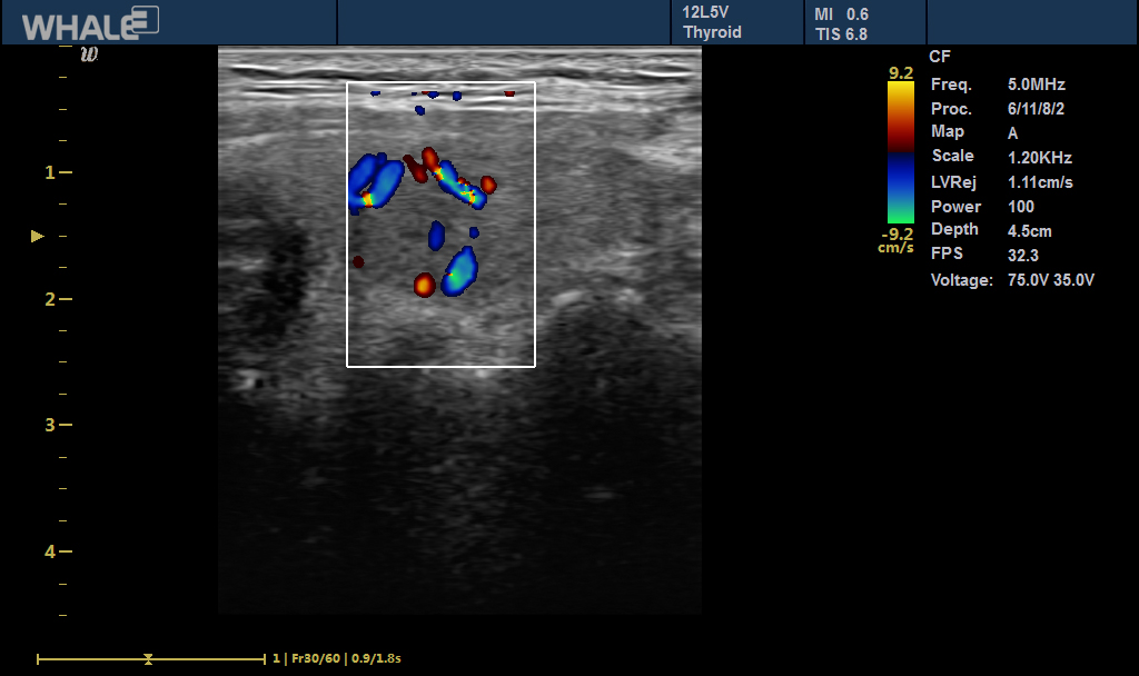 Sigma P5 Clinical Image Thyroid