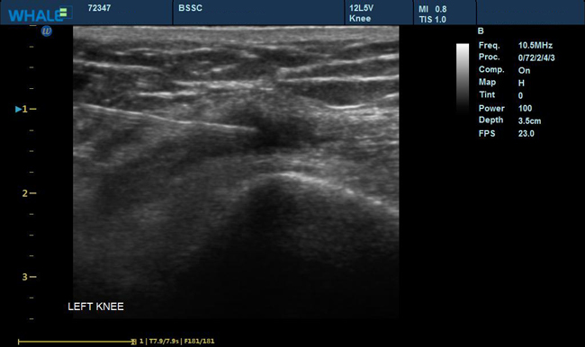 Sigma P5 Clinical Images Knee