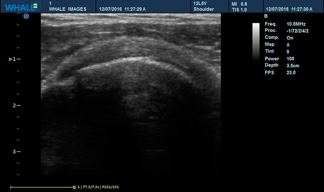 Sigma P5 Clinical Images Shoulder