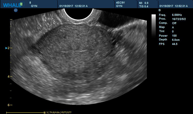 Sigma P5 Clinical Images Uterus
